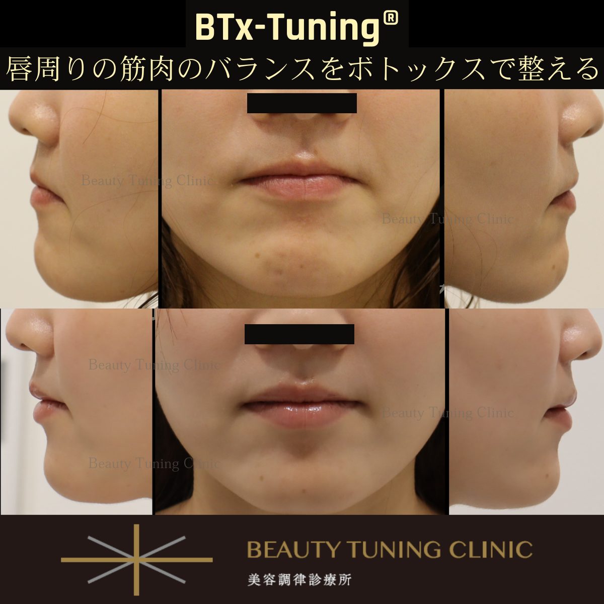 BTx-Tuning®：ボトックスで唇周りの筋肉のバランス調整（Lip Flip